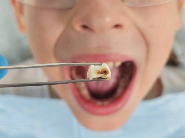Best Emergency Treatment for Dental Infections or Abscesses in Celebration, FL